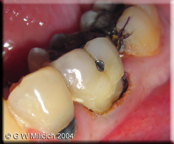 c6 tip gingivectomy 1 small.jpg